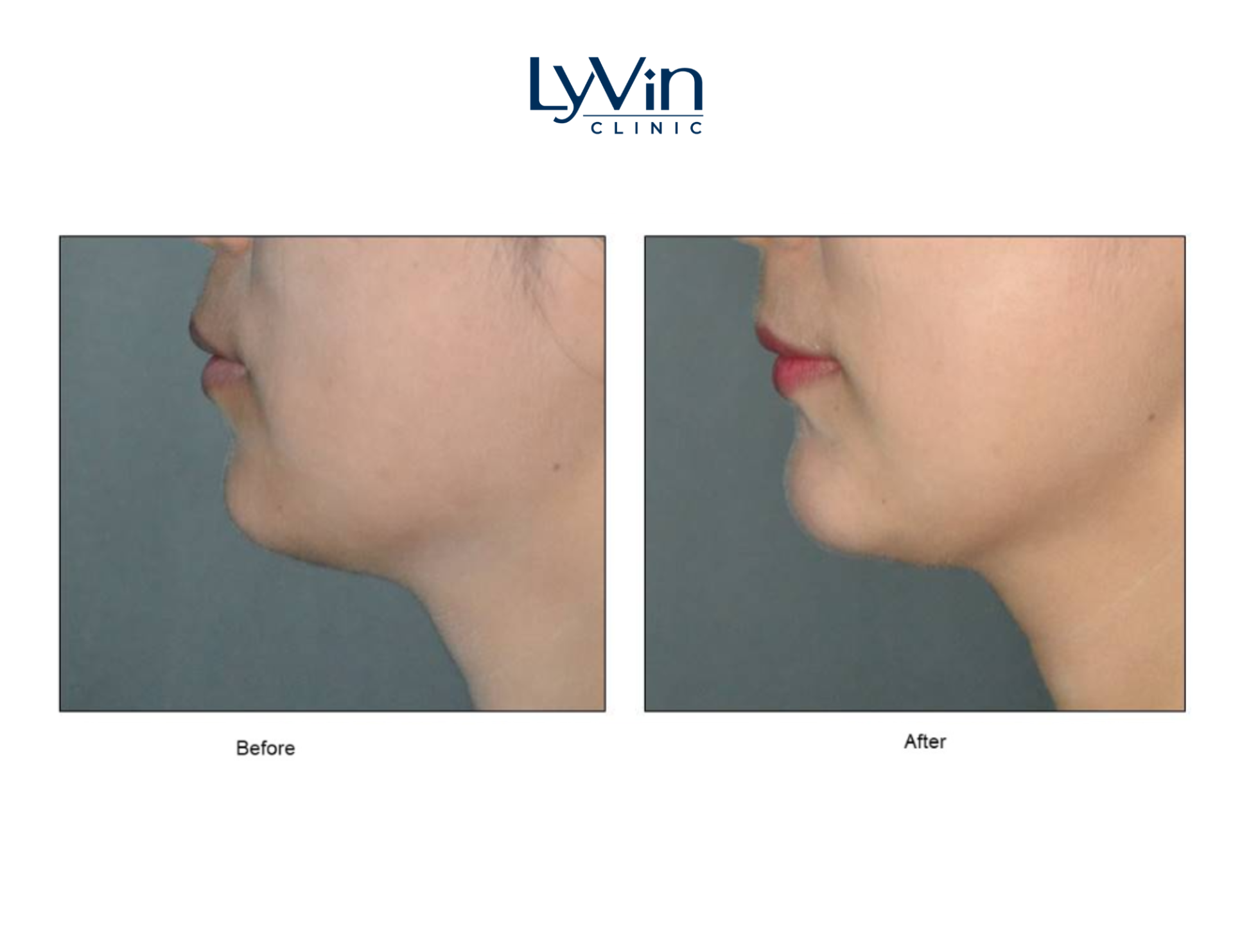 Chin Filler in Johor Bahru | Lyvin Clinic JB